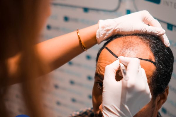 Processus de repousse après une greffe de cheveux