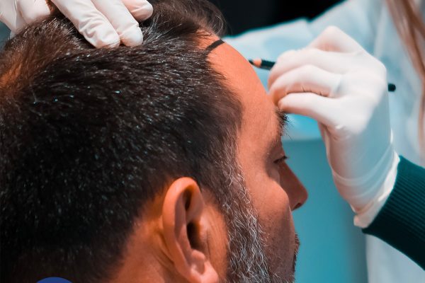 Quels sont les effets psychologiques de la perte de cheveux