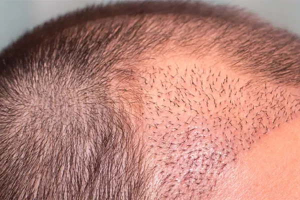 Trouver la Meilleur Clinique Greffe De Cheveux Turquie