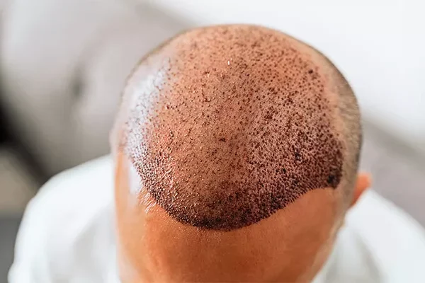 How many hair for 1000 grafts