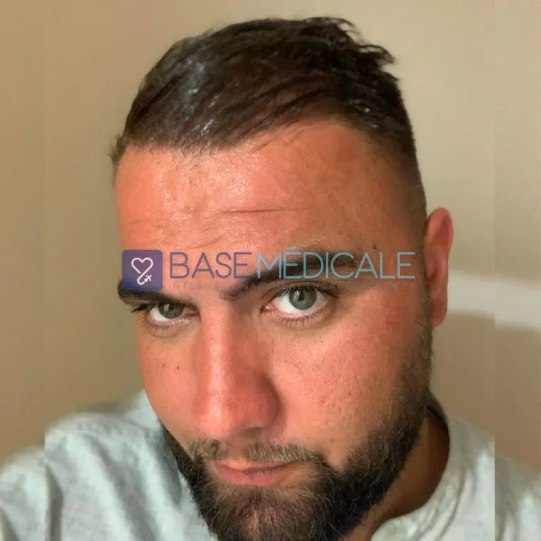 DHI Hair Transplant 4 DHI Hair Transplant