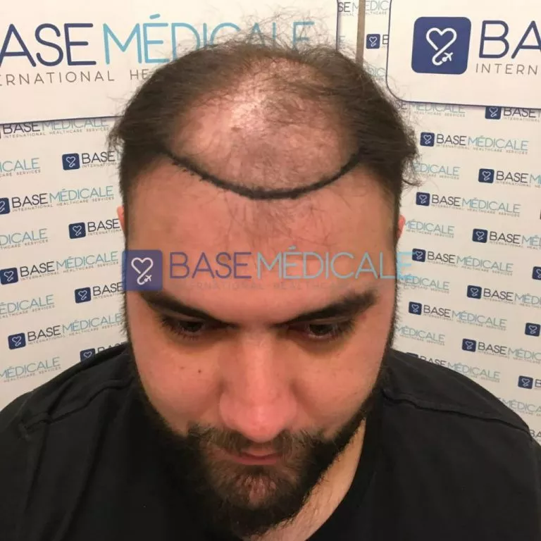 DHI Hair Transplant 3 DHI Hair Transplant