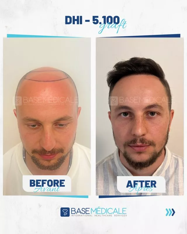 Greffe de Cheveux Turquie Prix 