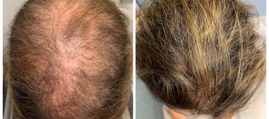 Is It Good To Use Minoxidil After Hair Transplant? 1 Is It Good To Use Minoxidil After Hair Transplant?