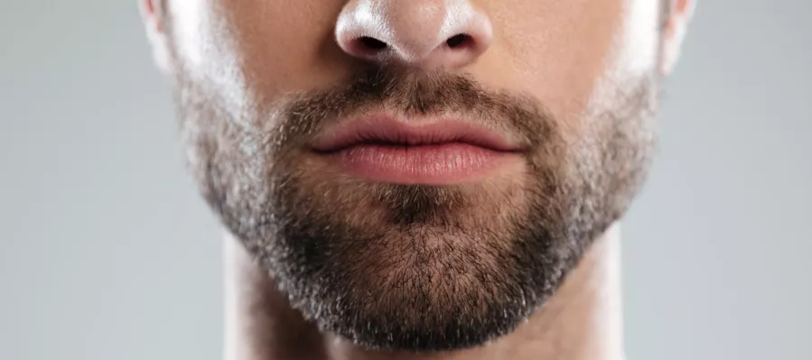 5 Things to Consider Before a Beard Transplant