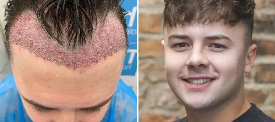 5 Things to Consider Before a Hair Transplant