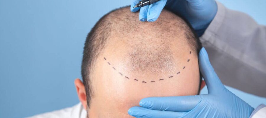 DHI Hair Transplant