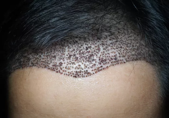 Greffe De Cheveux Après 10 Jours