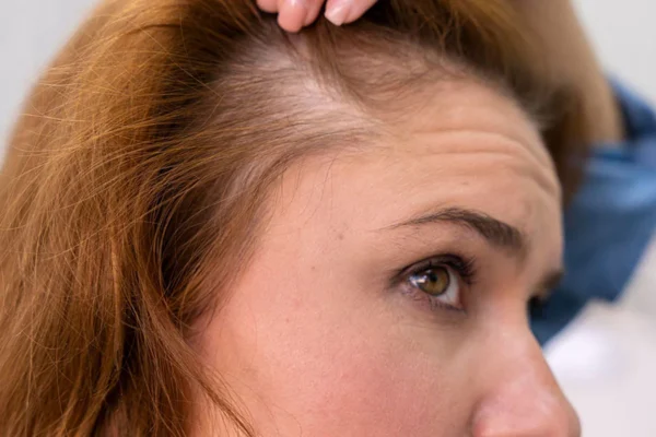 Greffe Des Cheveux Femme