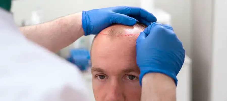 Quelle est la différence entre la greffe de cheveux en Turquie et en France ?