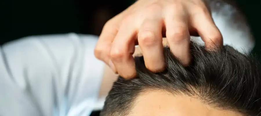 Comment cacher une greffe de cheveux ? 1 Comment cacher une greffe de cheveux ?