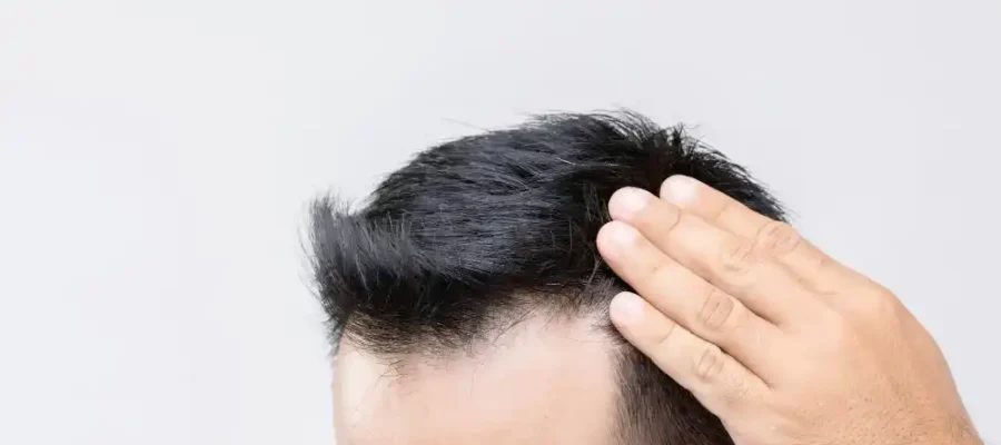 La greffe de cheveux en Turquie est-elle sûre ? 1 La greffe de cheveux en Turquie est-elle sûre ?