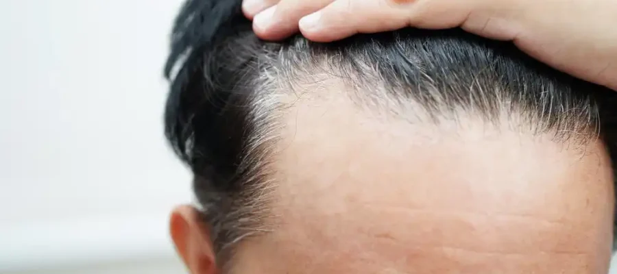 Quel est l'âge idéal pour une greffe de cheveux ? 1 Quel est l'âge idéal pour une greffe de cheveux ?